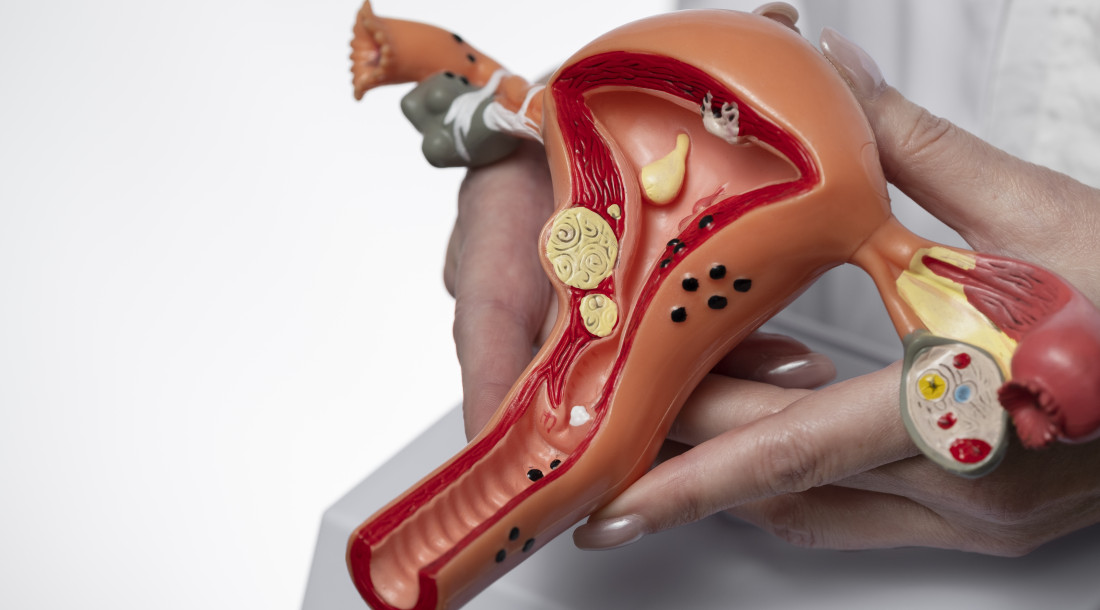 Endometriose